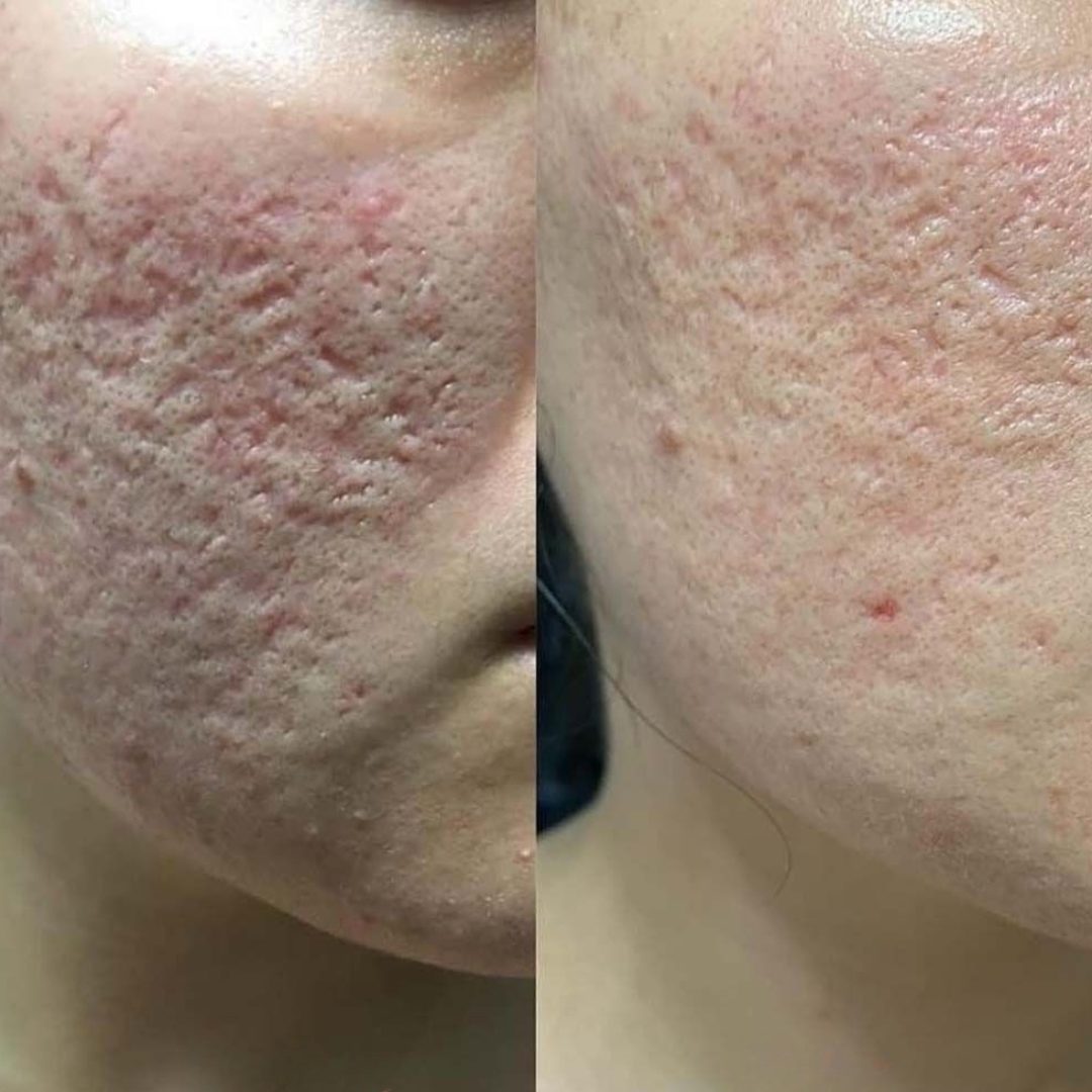 Textura mais refinada e marcas pós-acne atenuadas